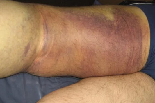 Treating a torn hamstring muscle with a massive haematoma