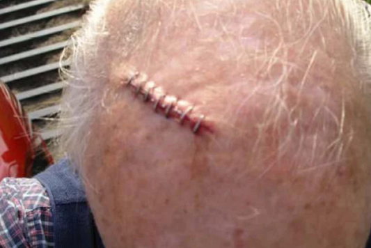 Using Photizo on a head injury to increase healing and reduce scarring