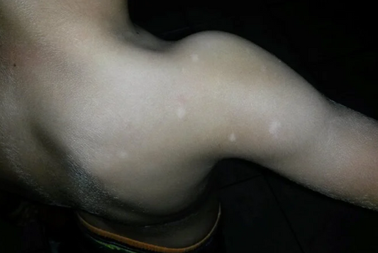 The effects of Photizo on vitiligo